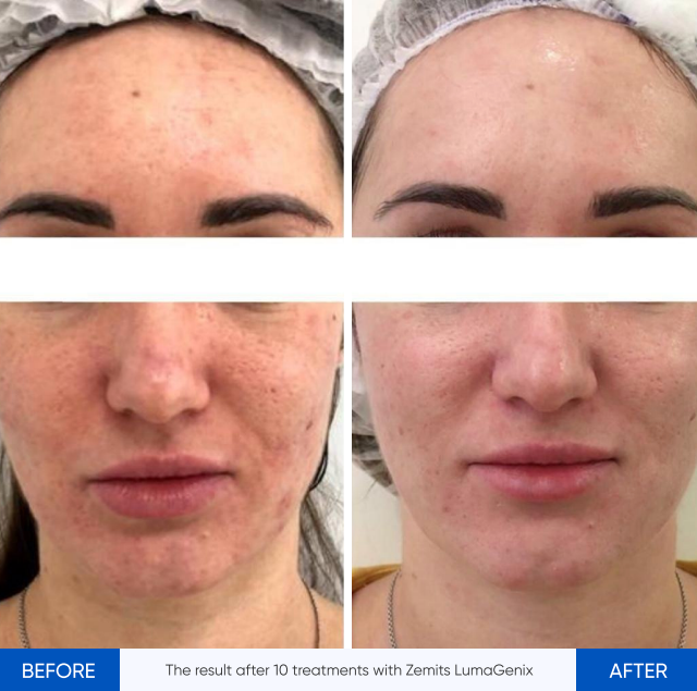 Zemits LumaGenix PDT ਪ੍ਰੋਫੈਸ਼ਨਲ ਐਲਈਡੀ ਲਾਈਟ ਥੈਰੇਪੀ ਡਿਵਾਈਸ