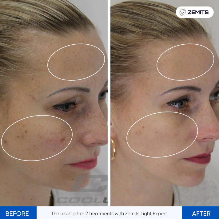 Zemits ਲਾਈਟ ਐਕਸਪਰਟ 2.0 IPL ਲੇਜ਼ਰ ਮਸ਼ੀਨ