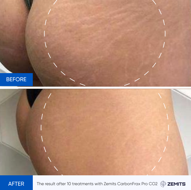 Zemits CarbonFrax Pro: CO2 ਭਾਗੀਦਾਰ ਲੇਜ਼ਰ