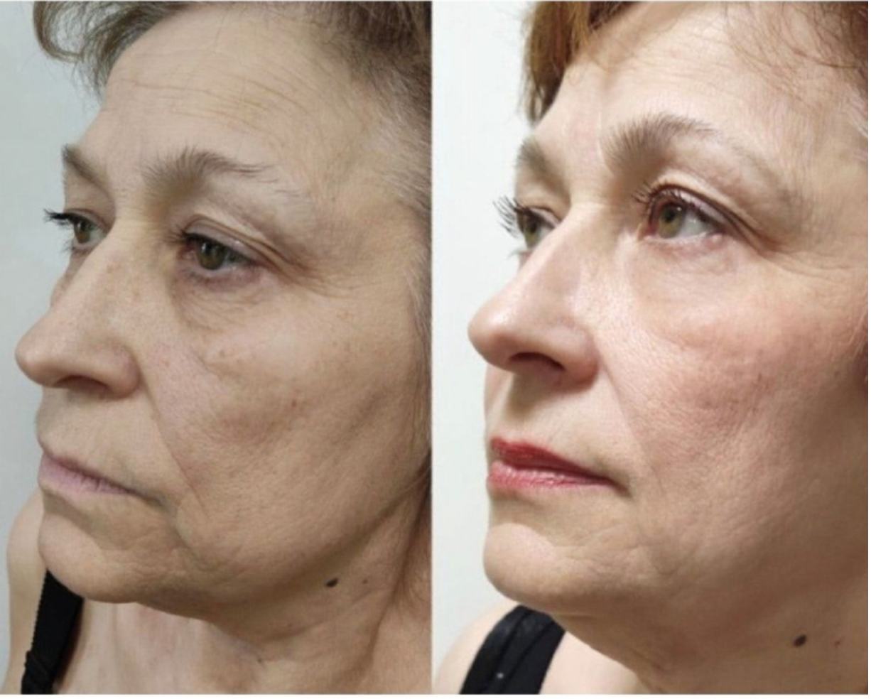 Zemits LumaGenix PDT ਪ੍ਰੋਫੈਸ਼ਨਲ ਐਲਈਡੀ ਲਾਈਟ ਥੈਰੇਪੀ ਡਿਵਾਈਸ