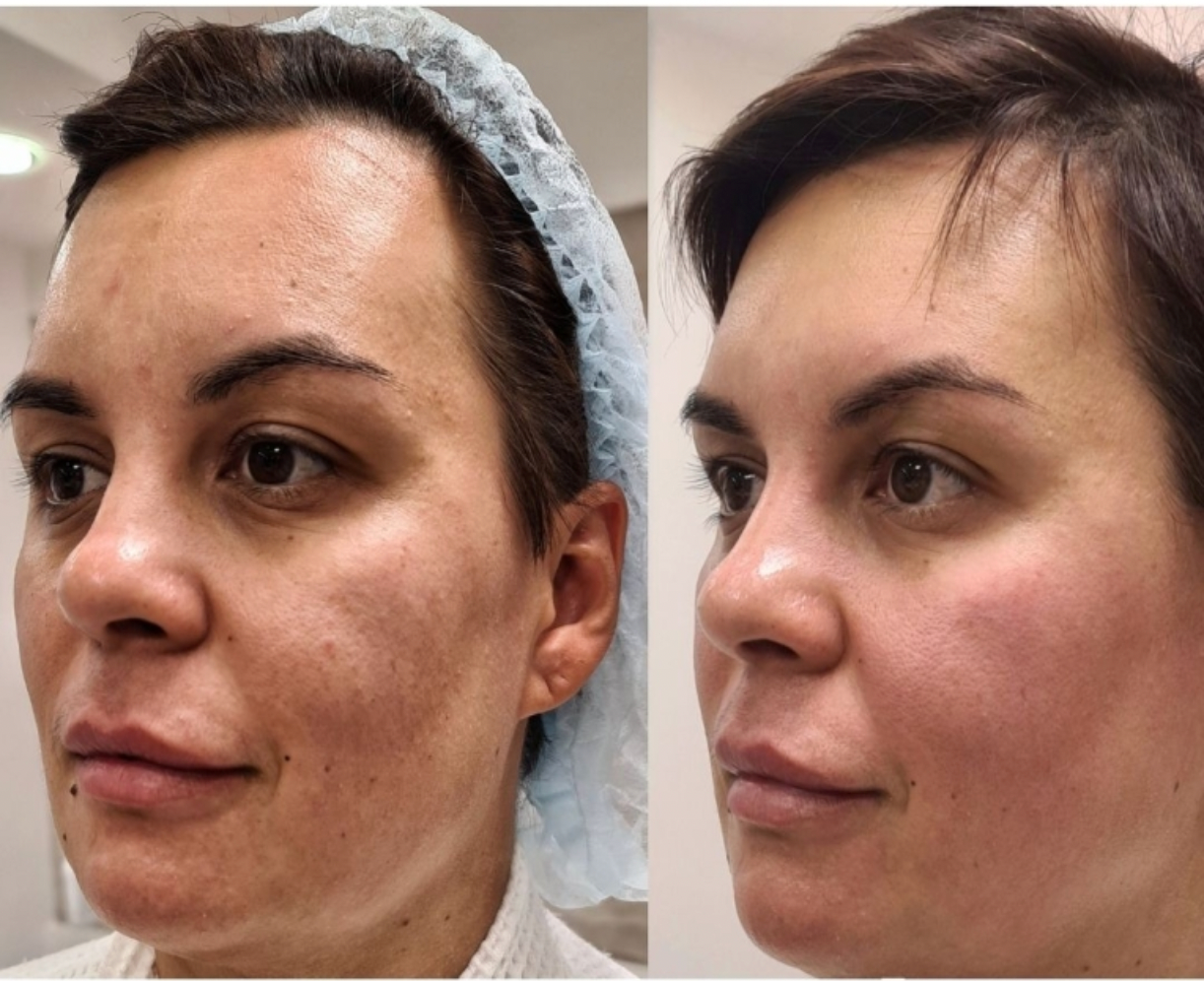 Zemits LumaGenix PDT ਪ੍ਰੋਫੈਸ਼ਨਲ ਐਲਈਡੀ ਲਾਈਟ ਥੈਰੇਪੀ ਡਿਵਾਈਸ