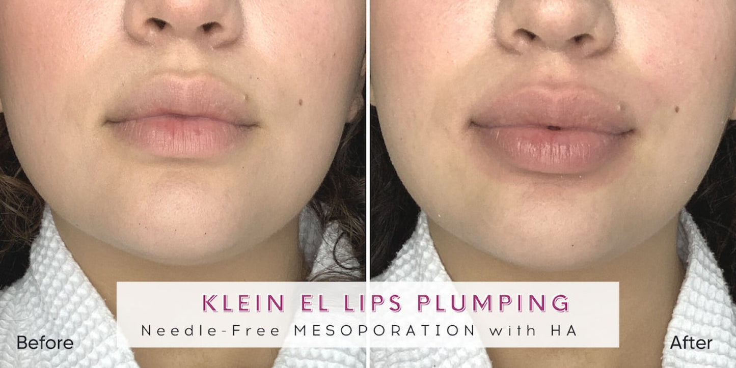 Zemits Klein EL ਇਲੈਕਟ੍ਰੋਪੋਰੇਸ਼ਨ ਸਿਸਟਮ