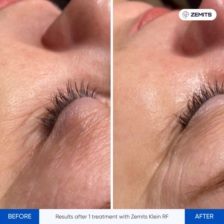 Zemits Klein RF ਚਮੜੀ ਕਸਰਤ ਪ੍ਰਣਾਲੀ