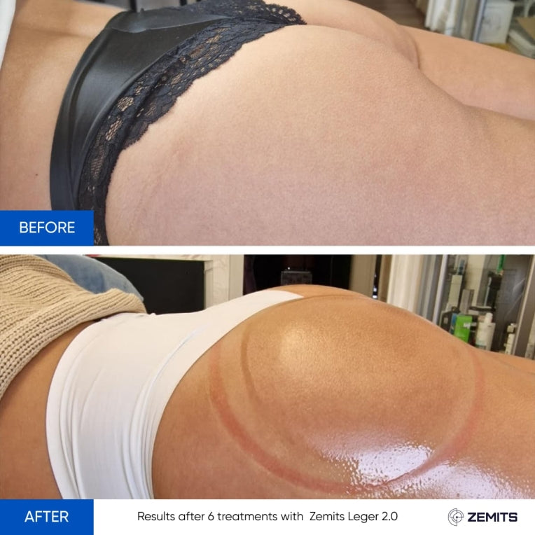 Zemits Leger 2.0 ਵੈਕਿਊਮ ਕੱਪਿੰਗ ਸਿਸਟਮ ਨਾਲ XXL ਕੱਪ ਸੈੱਟ ਵਿੱਚ