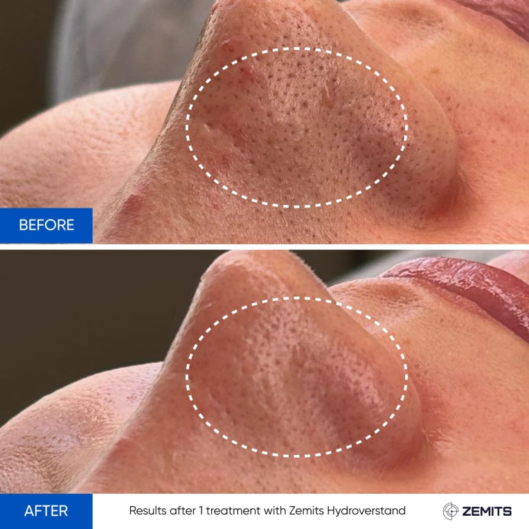 Zemits HydroVerstand PRO 7-ਇਨ-1 ਹਾਈਡ੍ਰੋਡਾਇਮੰਡ™ ਸਿਸਟਮ