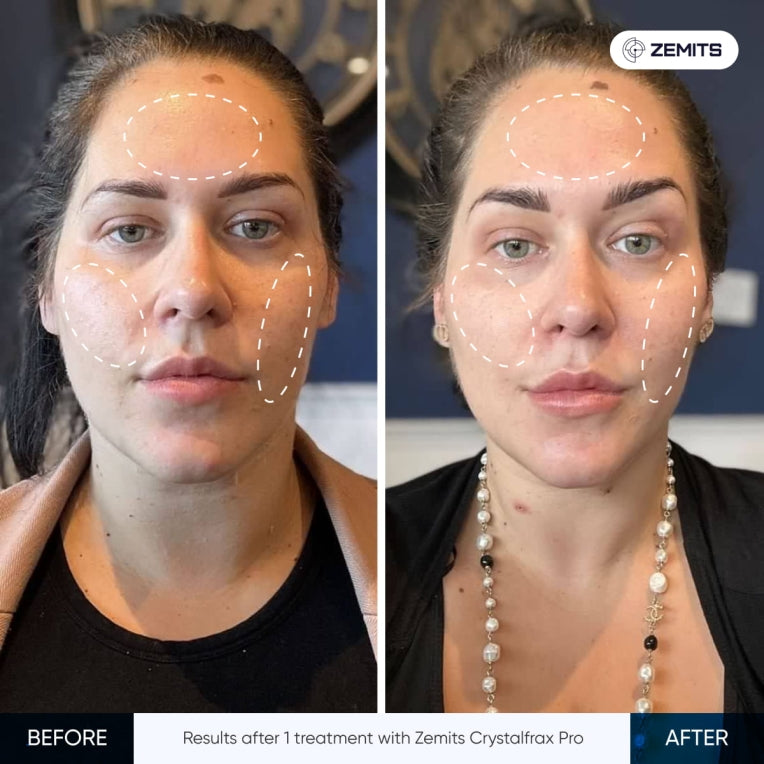 Zemits CrystalFrax PRO ਗੈਰ-ਆਕਰਮਣਕ ਅੰਸ਼ੀਕ RF ਪ੍ਰਣਾਲੀ