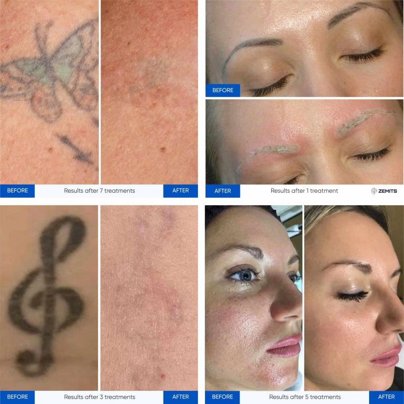 Zemits YAGenix ਕਿਊ-ਸਵਿੱਚਡ ਐਨਡੀ:ਯੈਗ ਲੇਜ਼ਰ